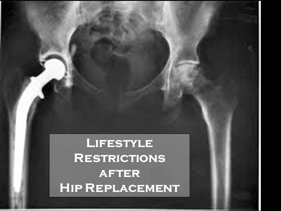 Lifestyle Restrictions after Hip Replacement